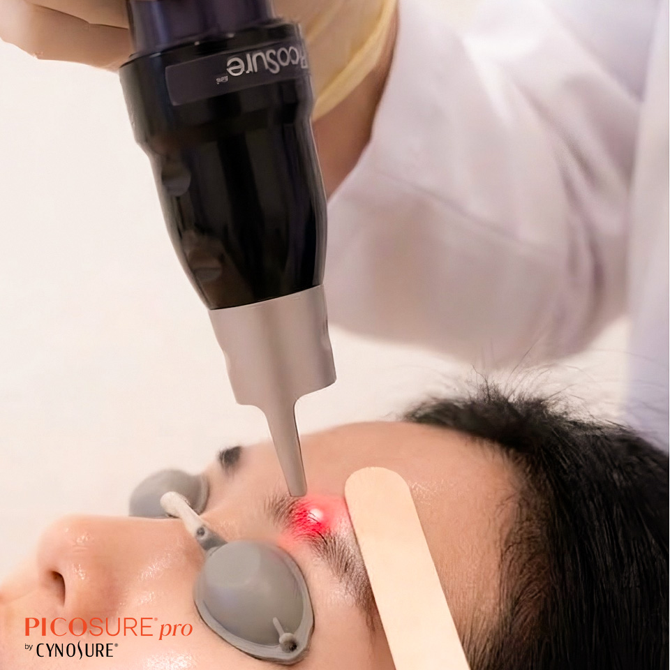 CNC004 – Laser xóa xăm mày