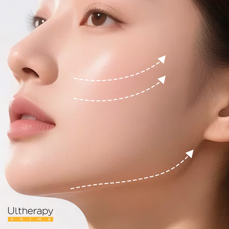 CNC005 – Nâng Cơ Utherapy Prime