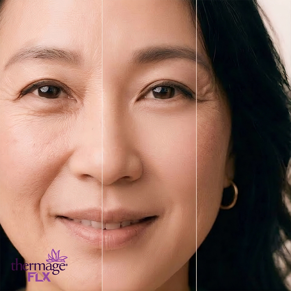 CNC007 – Trẻ hóa xóa nhăn mặt Thermage FLX