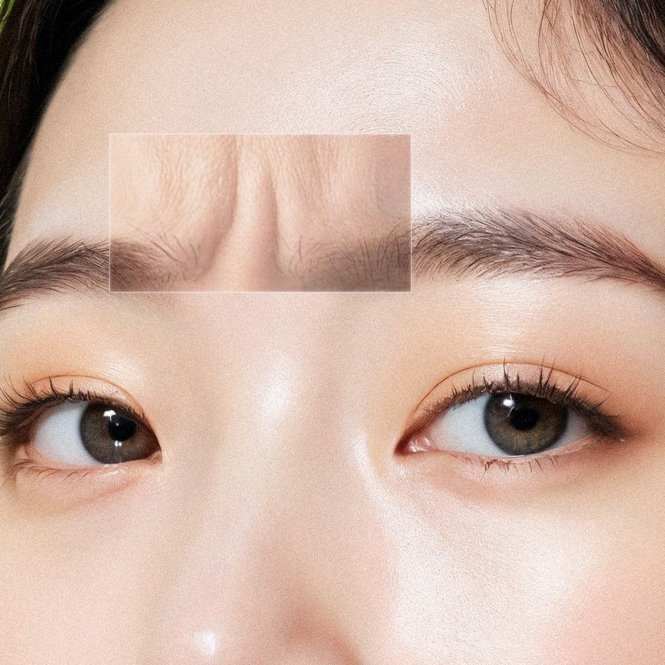 TTM002 – Xóa nhăn vùng cau mày