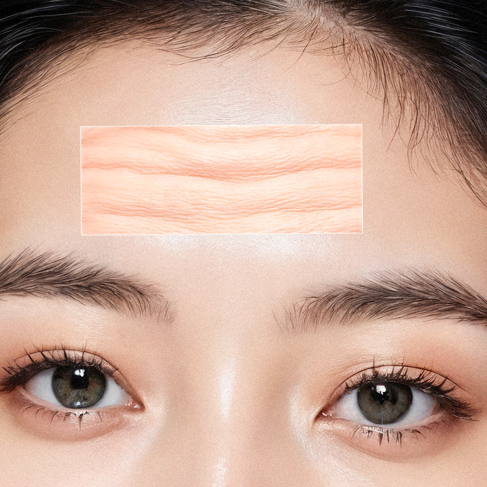 TTM003 – Xóa nhăn vùng trán