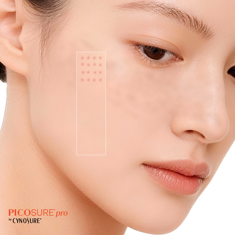 CNC002 – Laser Pico Pro điều trị nám