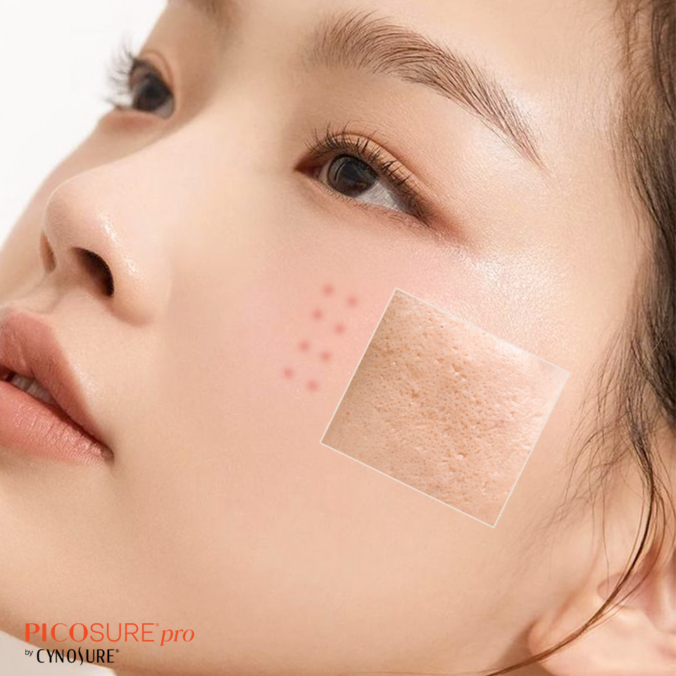 CNC003 – Laser Pico Pro điều trị sẹo mụn